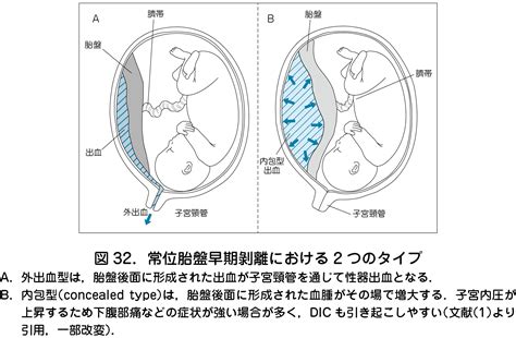 胎盤剝離後期|常位胎盤早期剥離とは？症状や兆候・原因は？